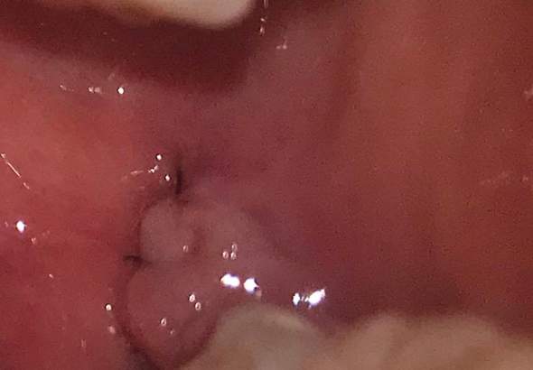 Weisheitszahn Op Faden Vergessen Gesundheit Und Medizin Zahne Weisheitszahne Weisheitszahn Op Faden Vergessen Gesundheit Und Medizin Zahne Weisheitszahne