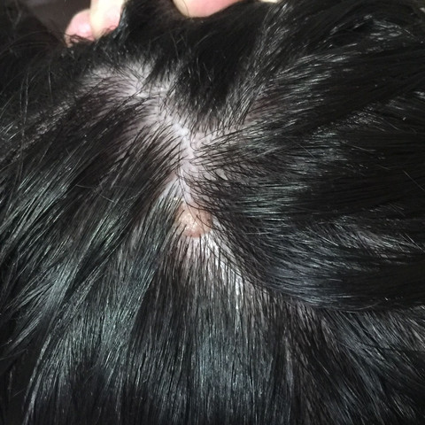 Weiss Einer Was Das Auf Meiner Kopfhaut Ist Es Ist Keine Warze Bzw Muttermal Sein Weiss Einer Was Das Auf Meiner Kopfhaut Ist Es Ist Keine Warze Bzw Muttermal Sein