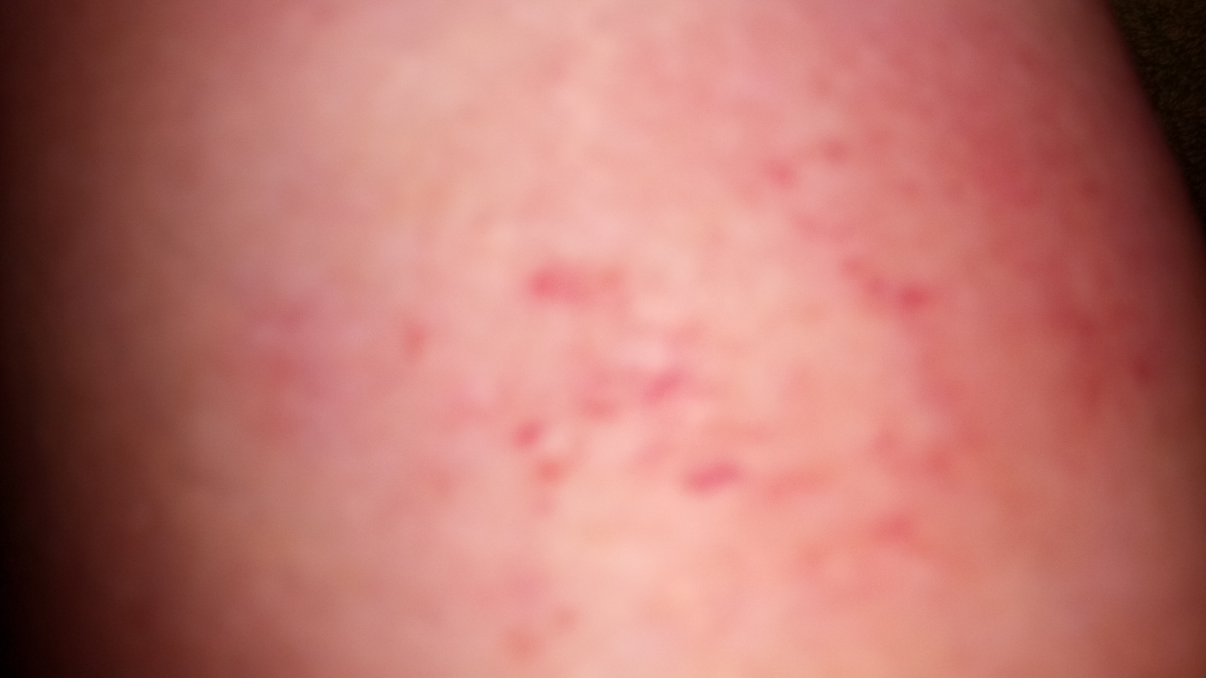 Weiß einer was das is? (Zeckenbiss, Gürtelrose) Weiß einer was das is? (Zeckenbiss, Gürtelrose)