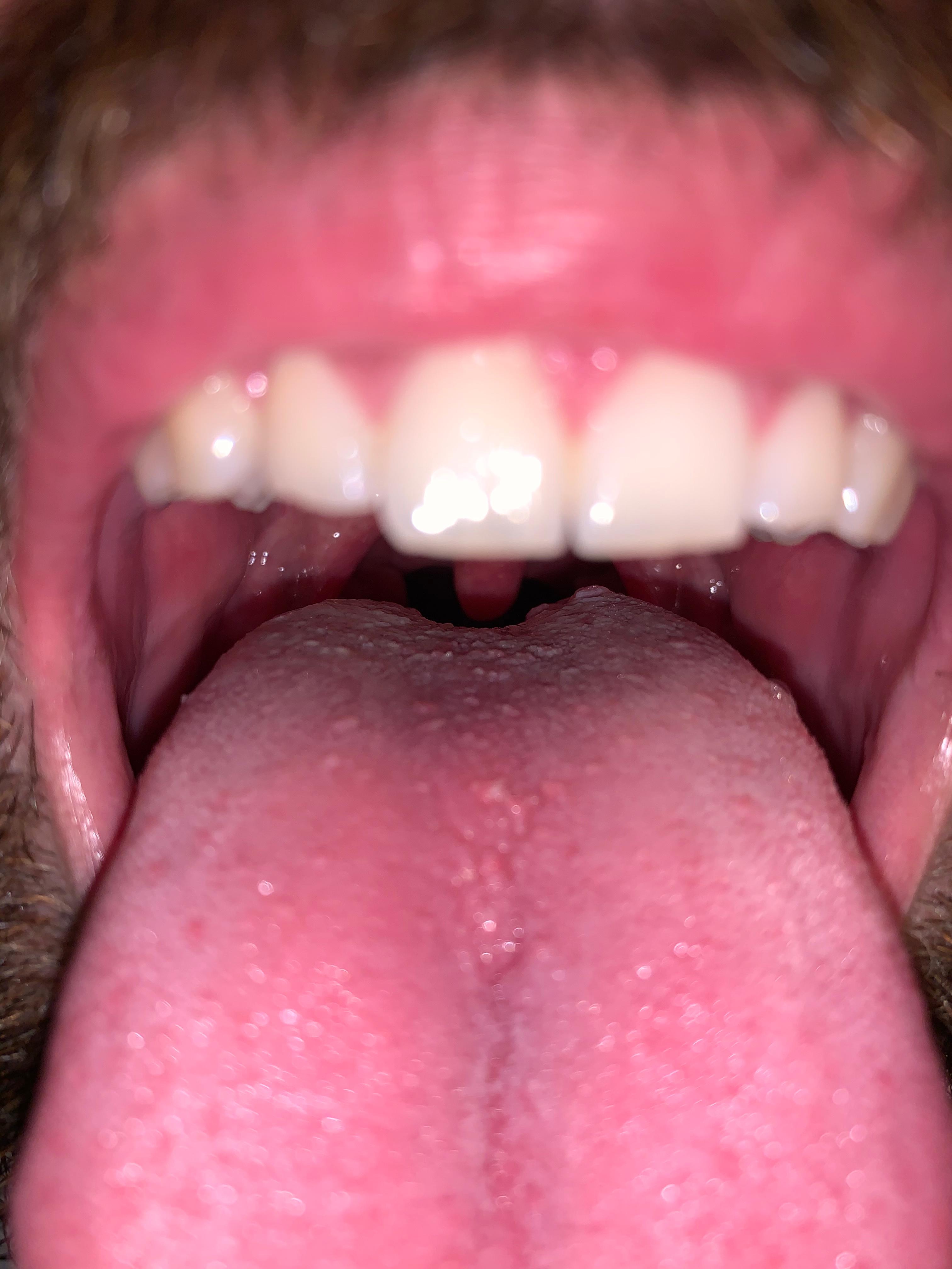 Weiß einer was das ist? (Gesundheit und Medizin, Zunge)