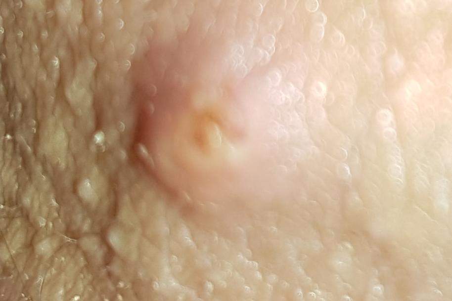 Weiss Einer Was Das Ist Ist Das Eine Knoten Unter Der Haut Angst Vor Krebs Weiss Einer Was Das Ist Ist Das Eine Knoten Unter Der Haut Angst Vor Krebs