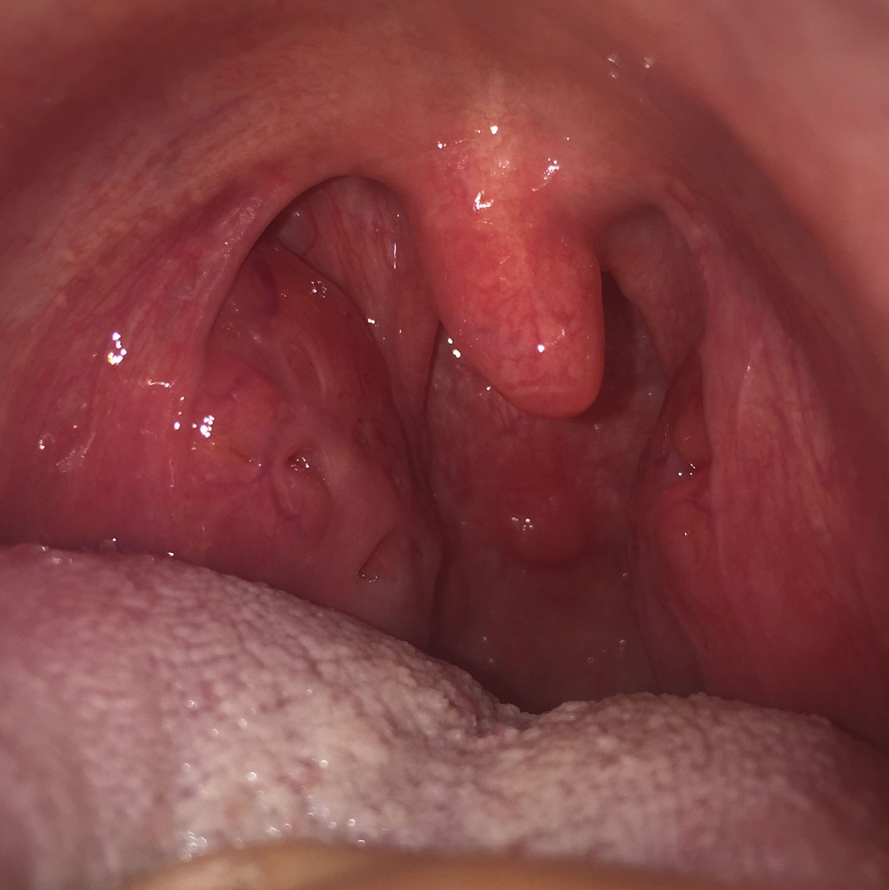 View Pickel Auf Der Zunge Vorne Was Tun Images