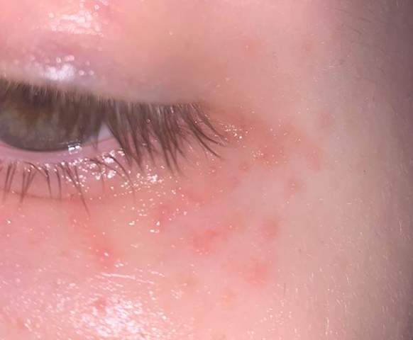 Unterm auge ausschlag Pickel unterm