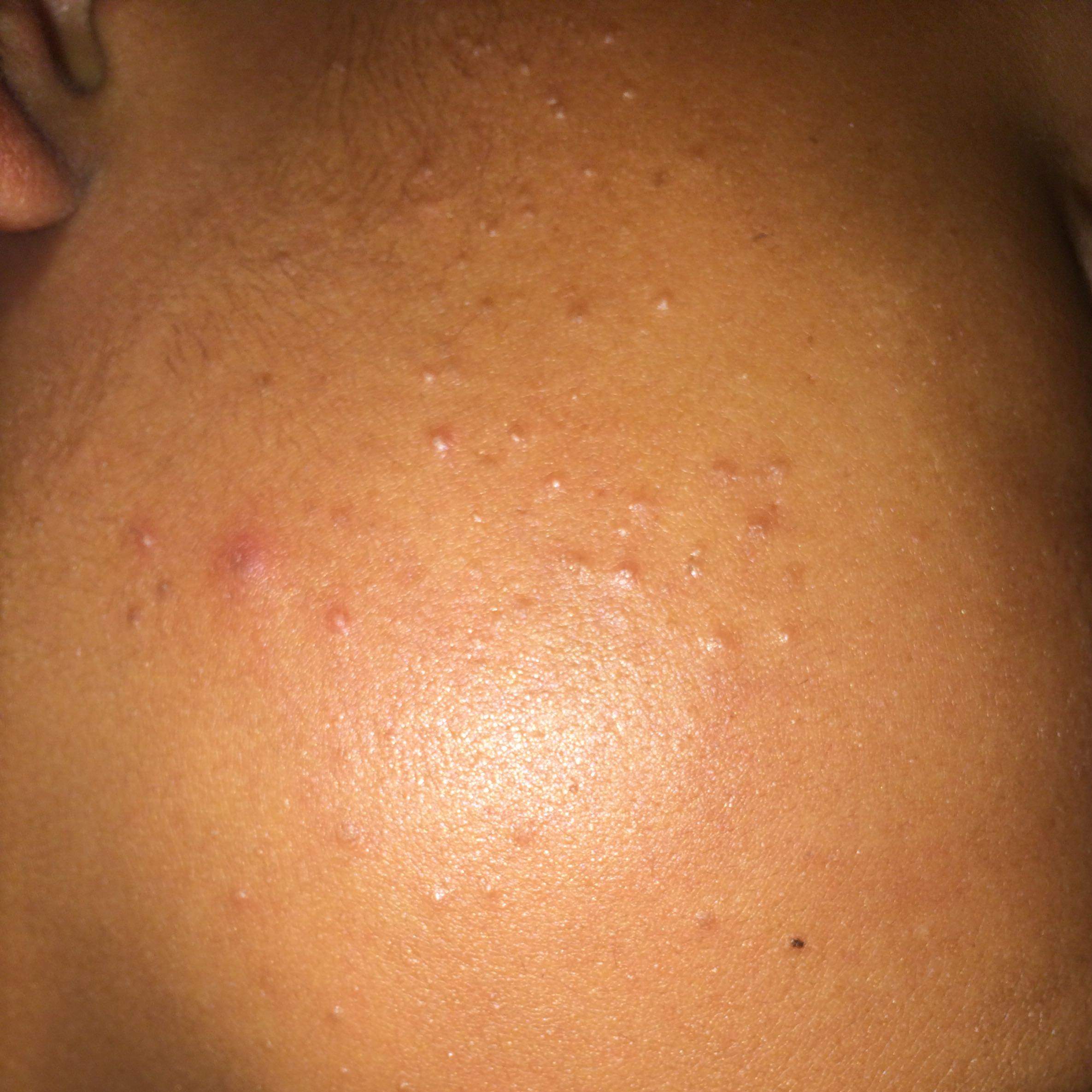 Wei� jemand was das für Pickel sind? (Pubertät, Akne) pickel auf der wange loswerden