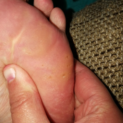 Fuß unterm schwarzer punkt Hautkrankheiten erkennen