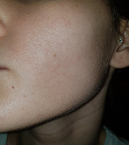 Weiss Jemand Was Das Ist Geht Das Von Alleine Wieder Weg Juckreiz Ausschlag Pusteln