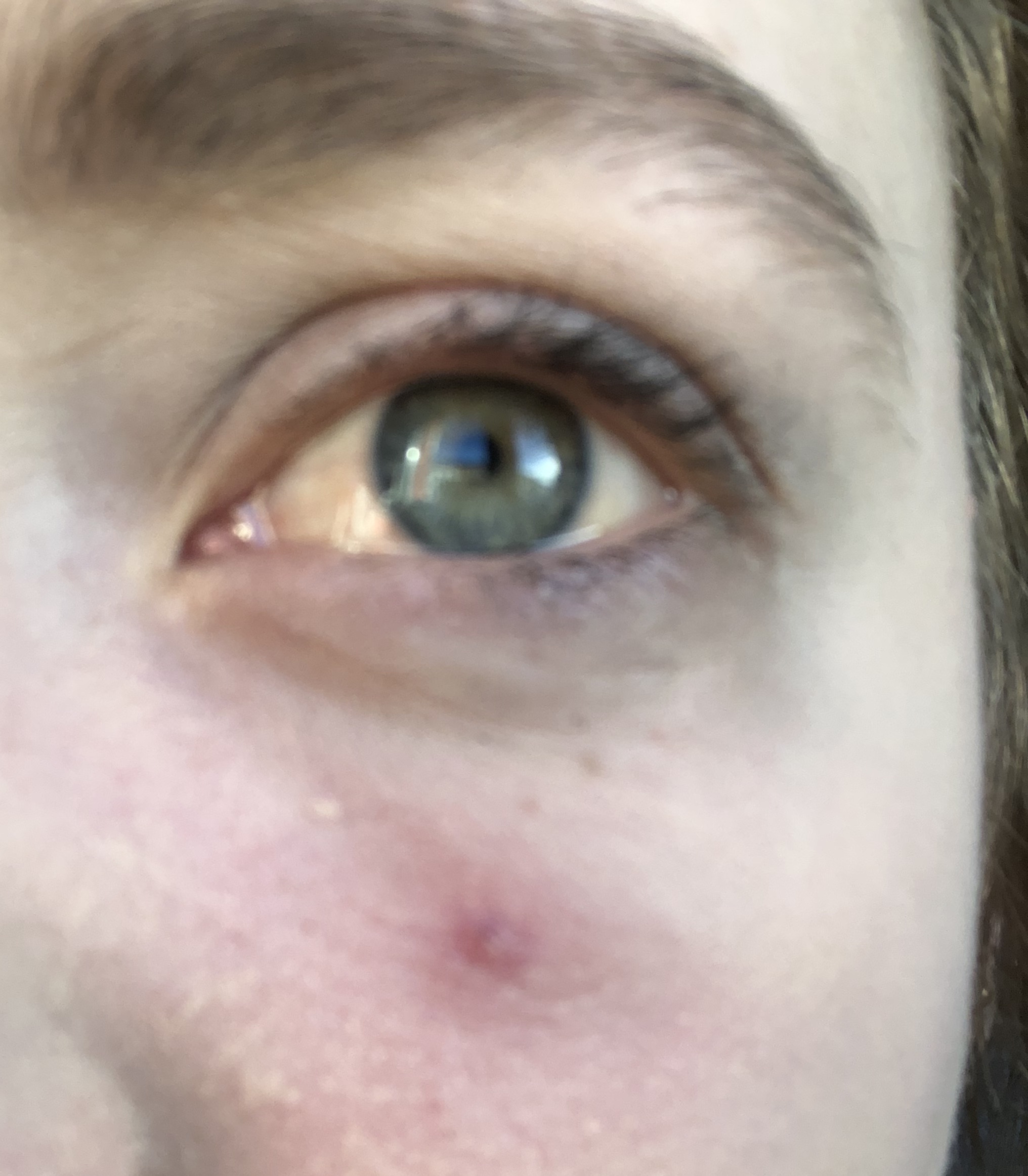 Weiß jemand was das ist? Normaler pickel? (Gesundheit und Medizin