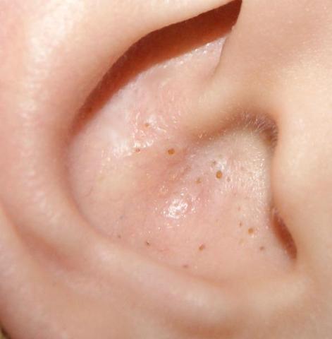 19+ Pickel Im Ohr Aufgegangen PNG