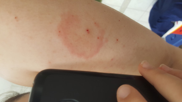 Mückenstich großer roter fleck