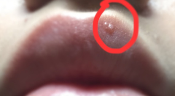 Weiss Jemand Was Das Sein Konnte Siehe Bild Hatt Schon Seit Monaten Ein Kleines Blaschen Doch Jetzt Sind Es 3 Geworden Gesundheit Und Medizin Lippe Blaeschen Weiss Jemand Was Das Sein Konnte Siehe Bild Hatt Schon Seit Monaten Ein Kleines Blaschen Doch Jetzt Sind Es 3 Geworden Gesundheit Und Medizin Lippe Blaeschen
