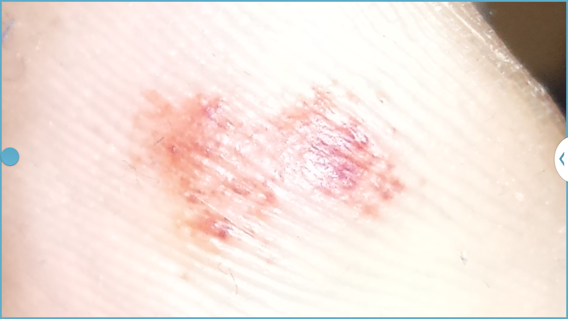 Arthrose Im Grossen Zeh Bilder