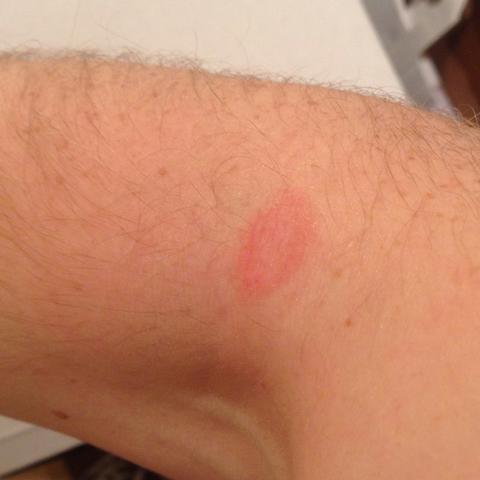 Weiss jemand was dieser Roter Fleck auf meiner Haut zu bedeuten hat? 