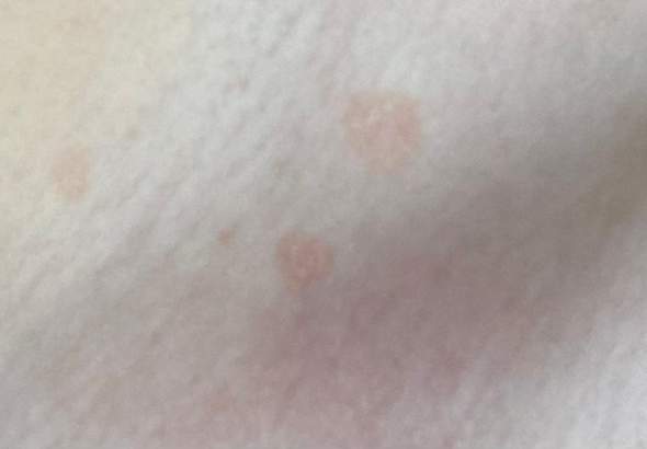 Weiß jemand wie diese Hautkrankheit heißt?