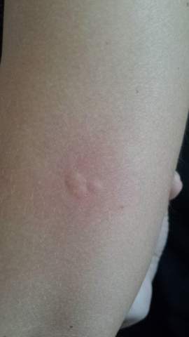 Weiss Jemand Zufallig Was Das Ist Biss Ausschlag Haut