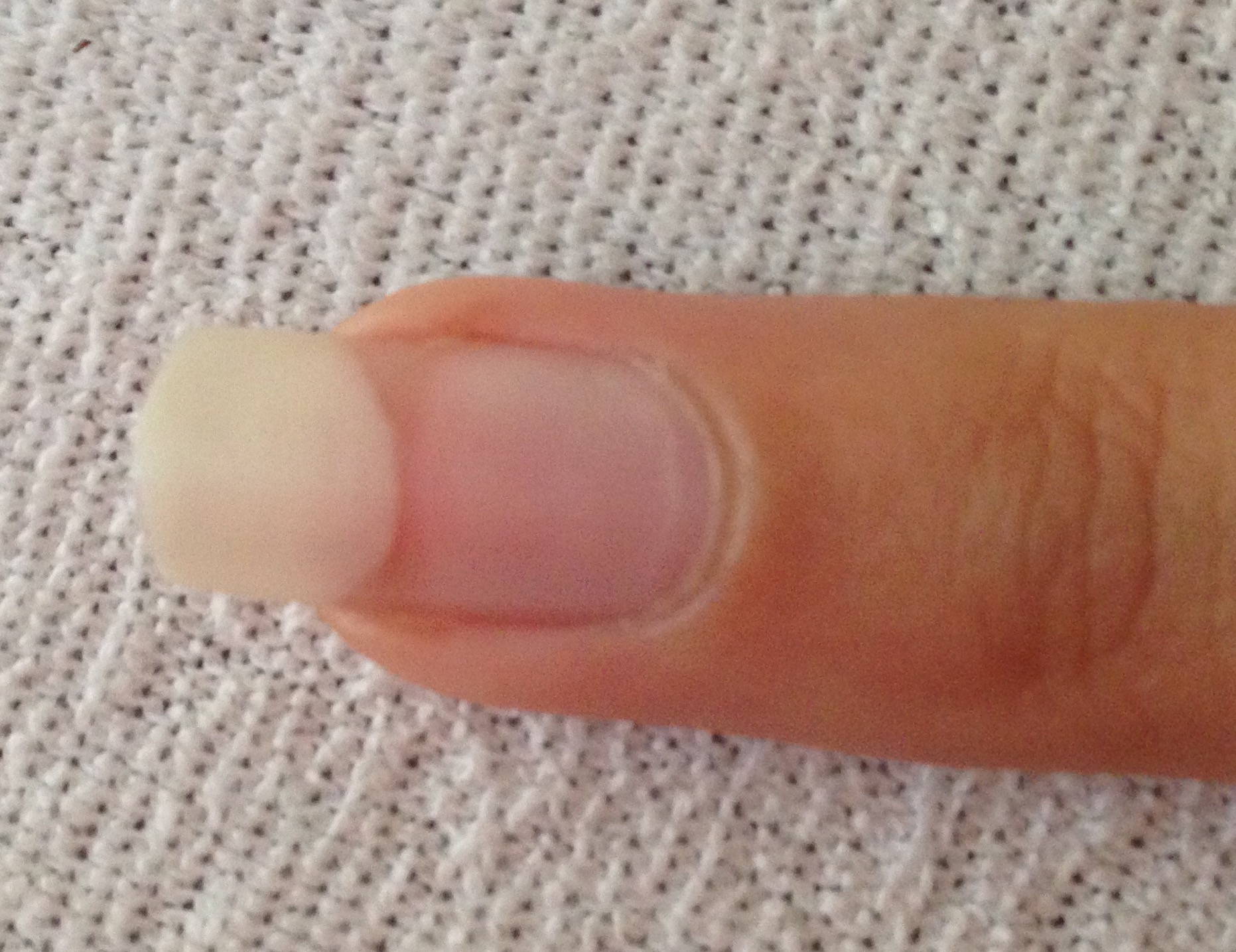 Weiß vom Fingernagel ungleichmäßig? (Fingernägel)