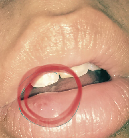 Weiss Wer Was Das Ist Bzw Auch Wie Man Es Behandelt Gesundheit Lippe Weiss Wer Was Das Ist Bzw Auch Wie Man Es Behandelt Gesundheit Lippe