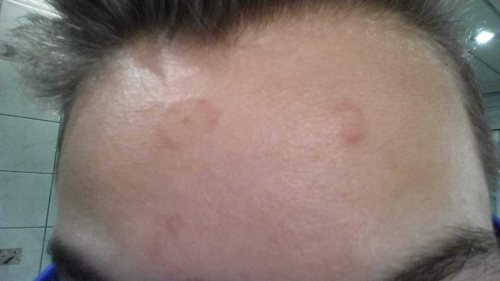 Weisse Rot Umrandete Flecken Im Gesicht Gesundheit Haut Ausschlag Weisse Rot Umrandete Flecken Im Gesicht Gesundheit Haut Ausschlag