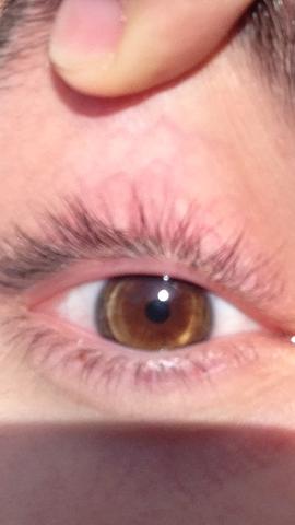 Weisse Ablagerungen Im Auge Arzt Augen Weiss Weisse Ablagerungen Im Auge Arzt Augen Weiss