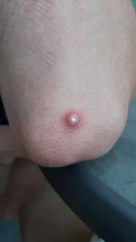 Weisse Beule Unter Der Haut Gesundheit Und Medizin Weisse Beule Unter Der Haut Gesundheit Und Medizin