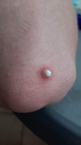 Weisse Beule Unter Der Haut Gesundheit Und Medizin Weisse Beule Unter Der Haut Gesundheit Und Medizin