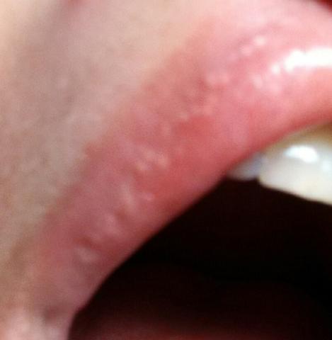 Weisse Beulen Auf Der Lippe Gesundheit