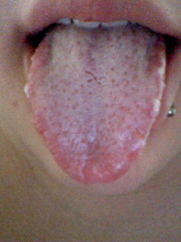 Weisse Blaschen Am Rand Der Zunge Gesundheit Medizin Mund Weisse Blaschen Am Rand Der Zunge Gesundheit Medizin Mund