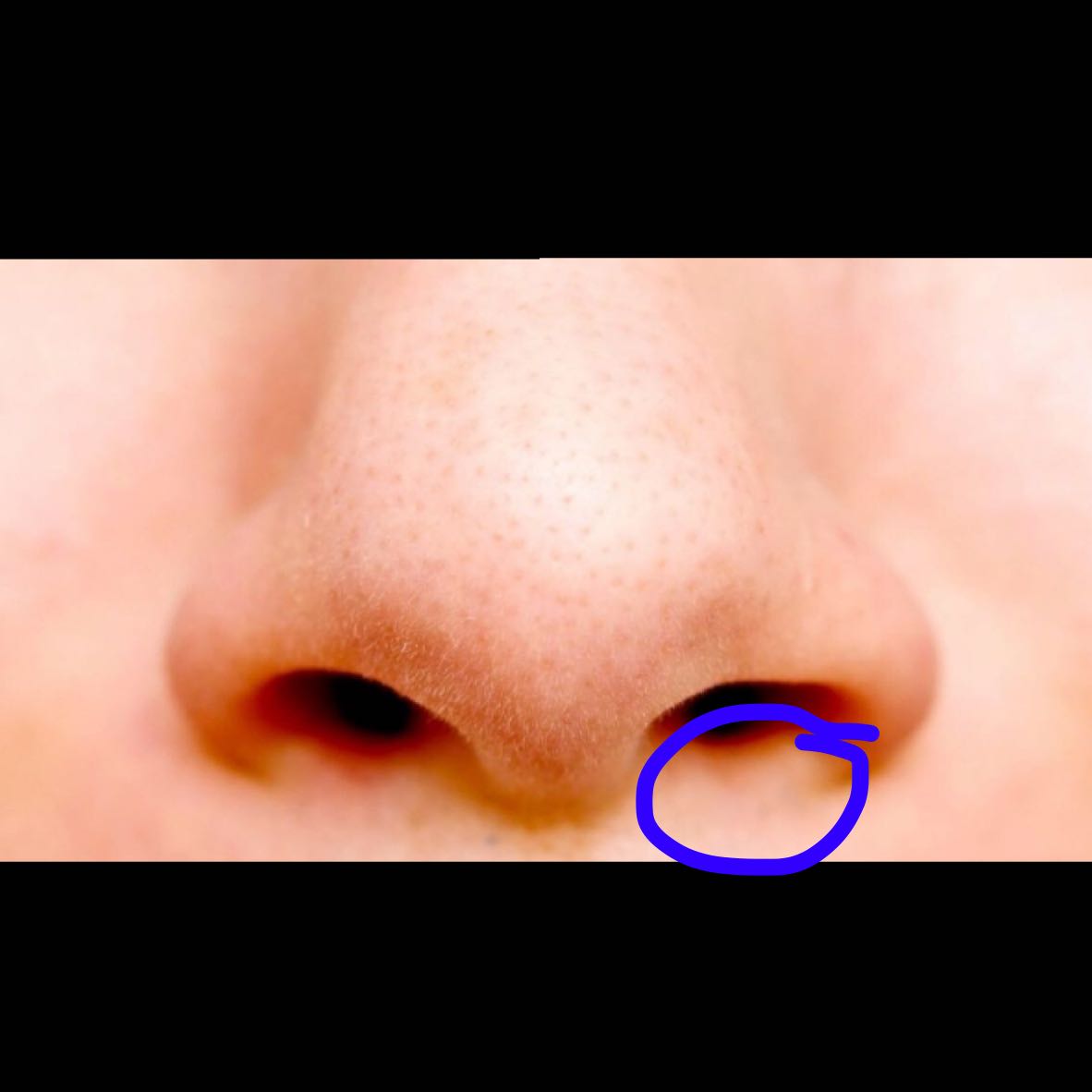 Weisse Bläschen bei der Nase wegen Schnupfen? (Gesundheit und Medizin
