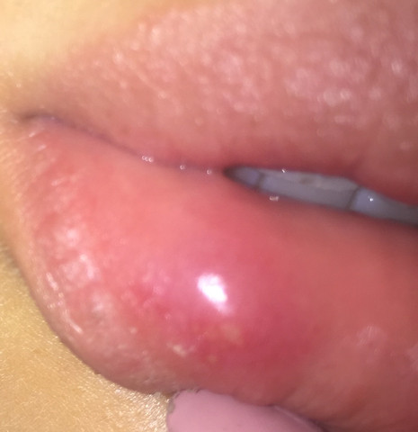 Get Pickel An Der Lippe Ausgedrückt Pics