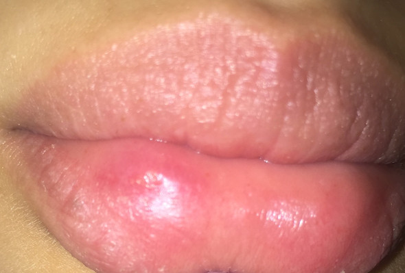 Oder Aphten? Oder was anderes? - (Schmerzen, Lippe, Herpes)