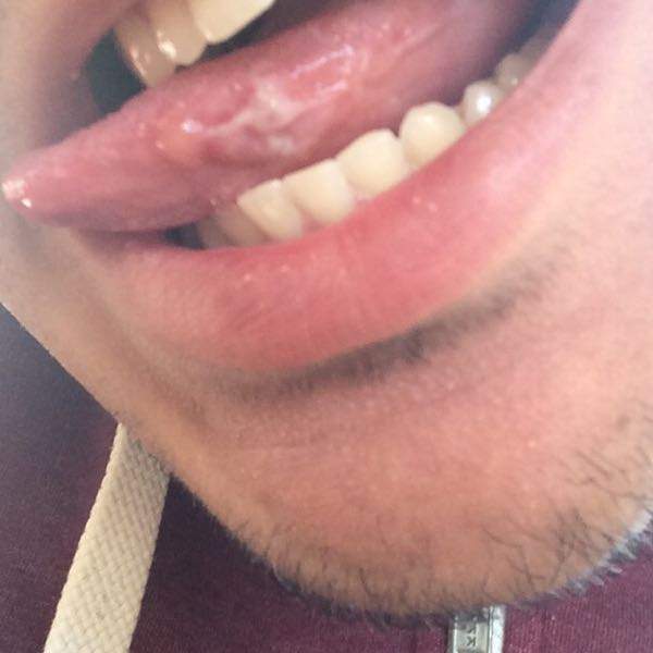 Zunge eiterbläschen Bläschen auf