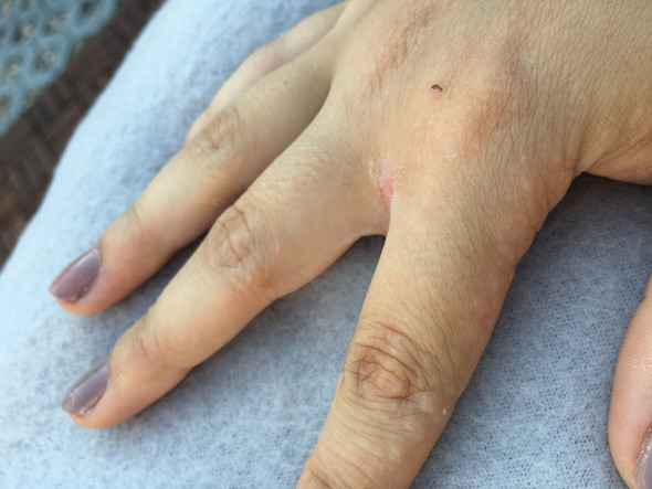 Weisse Blasen An Den Fingern Juckreiz Gesundheit Hand Weisse Blasen An Den Fingern Juckreiz Gesundheit Hand