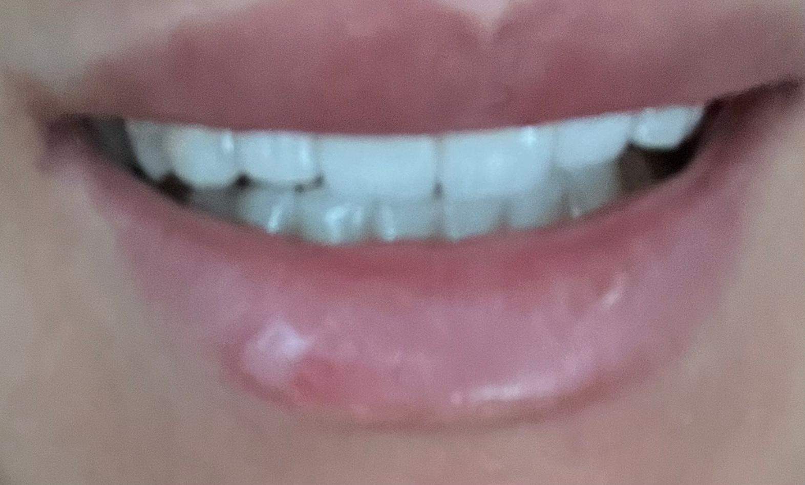 Lippenherpes Weiße Bläschen Auf Der Lippe Bilder