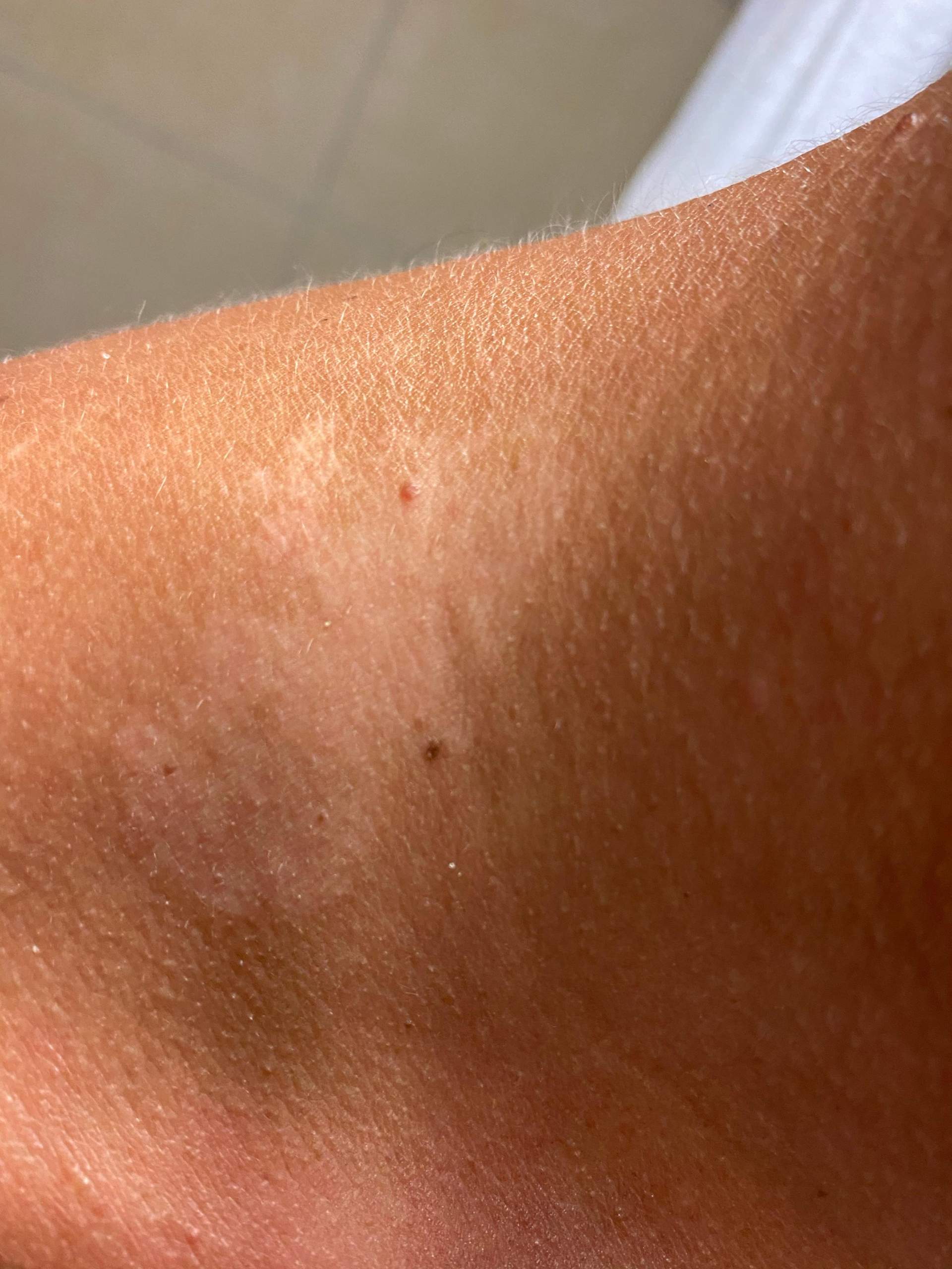 Penis pigmentstörung Hautstörungen am