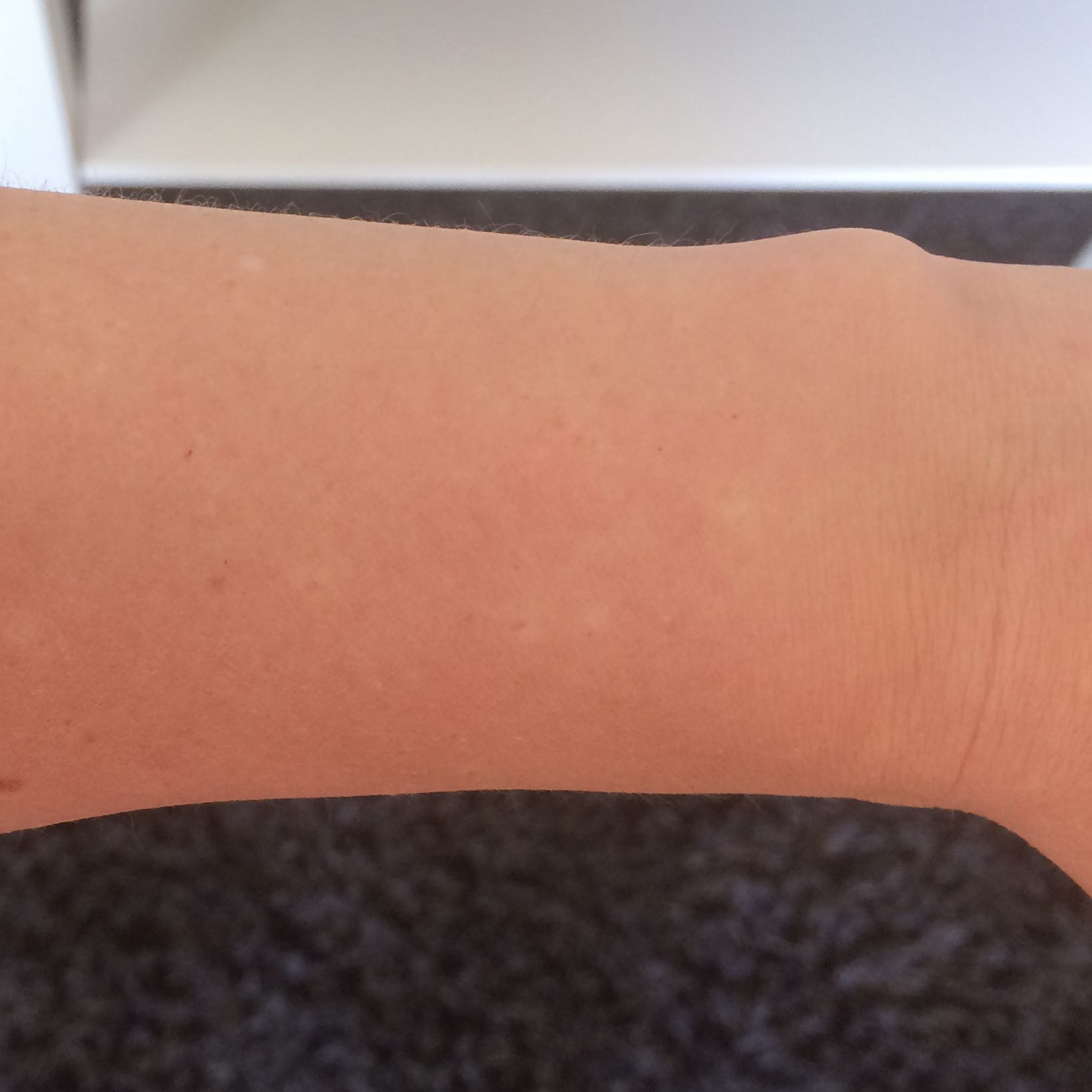 Weiße Flecken was ist das nur? (Krankheit, Haut, Punkte)