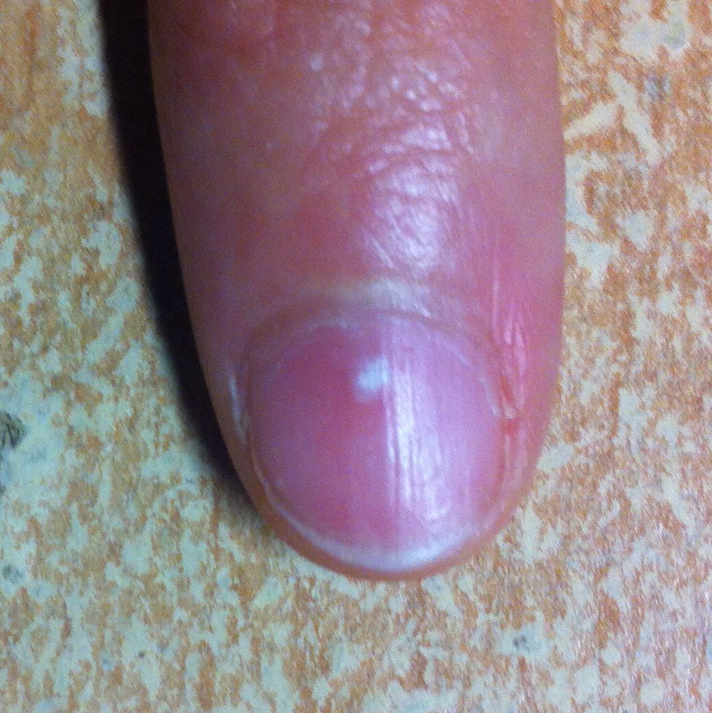 Weiße Flecken an den Nägeln, was ist das? (Fingernägel)