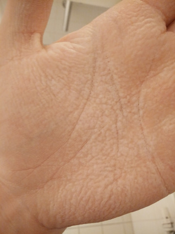 Handfläche weiße flecken Weiße Wunden