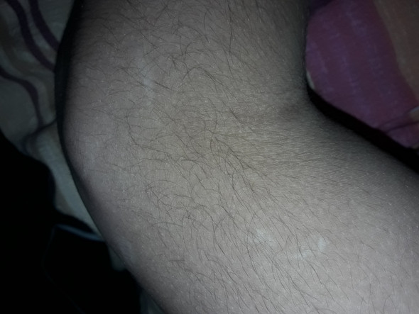 Weisse Flecken An Meiner Haut Arm Weisse Flecken An Meiner Haut Arm