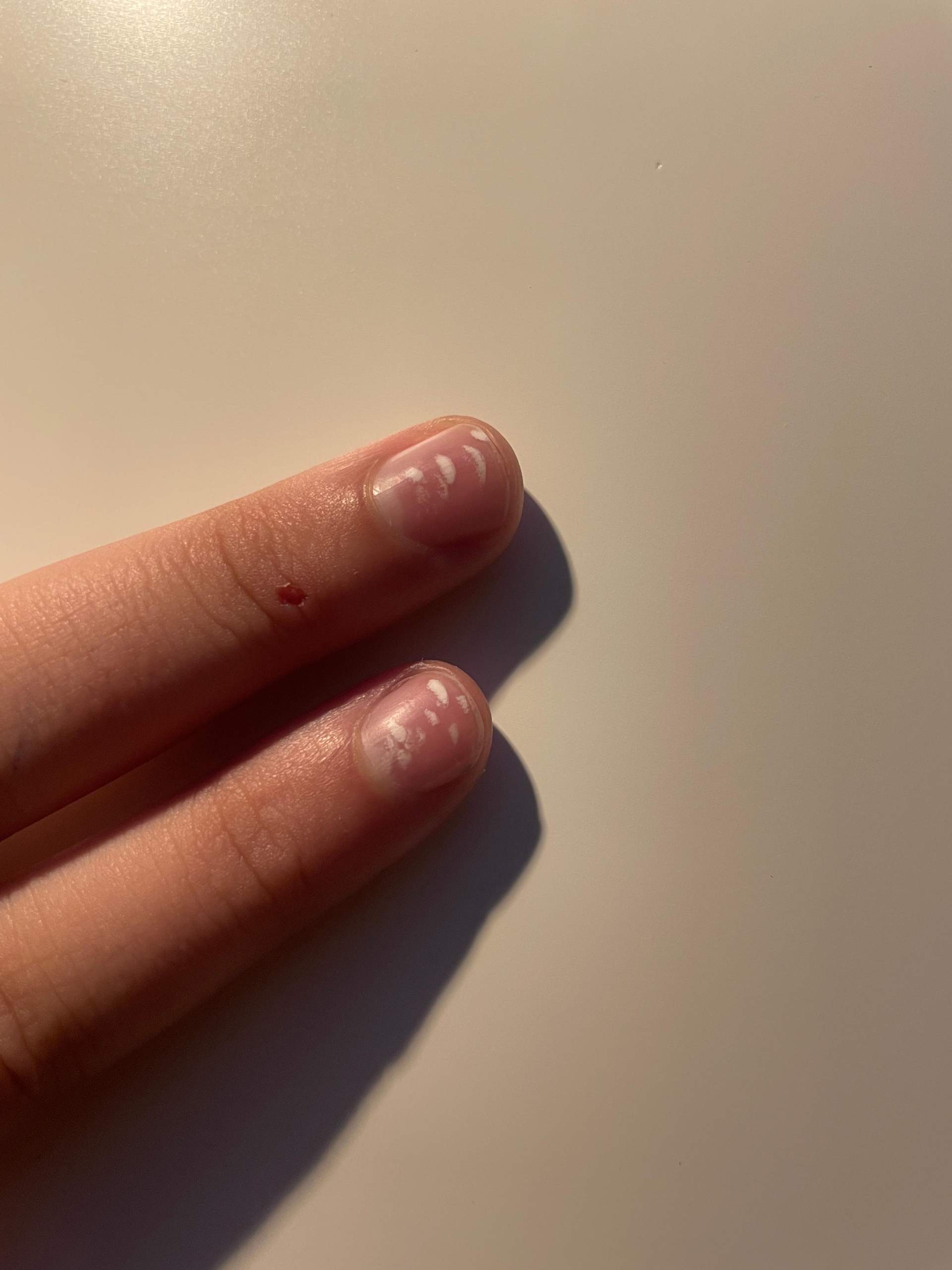 Weiße Flecken auf dem Fingernagel? (Gesundheit und Medizin)