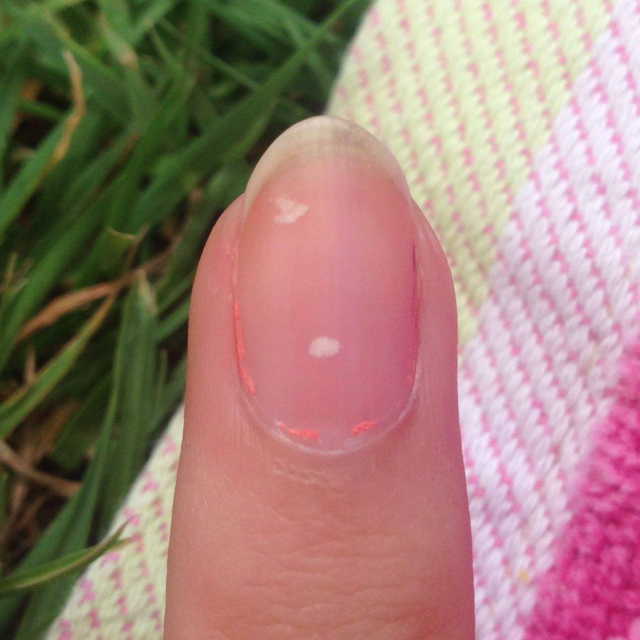 Weiße Flecken auf den Nägeln? Woher? (Nägel, Hand, Finger)
