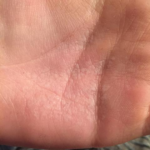 Weiße Flecken auf der Hand?
hi. immer wenn ich meine Hände wasche krieg ich diese weissen flecke auf meiner Hand. Was kann das sein?