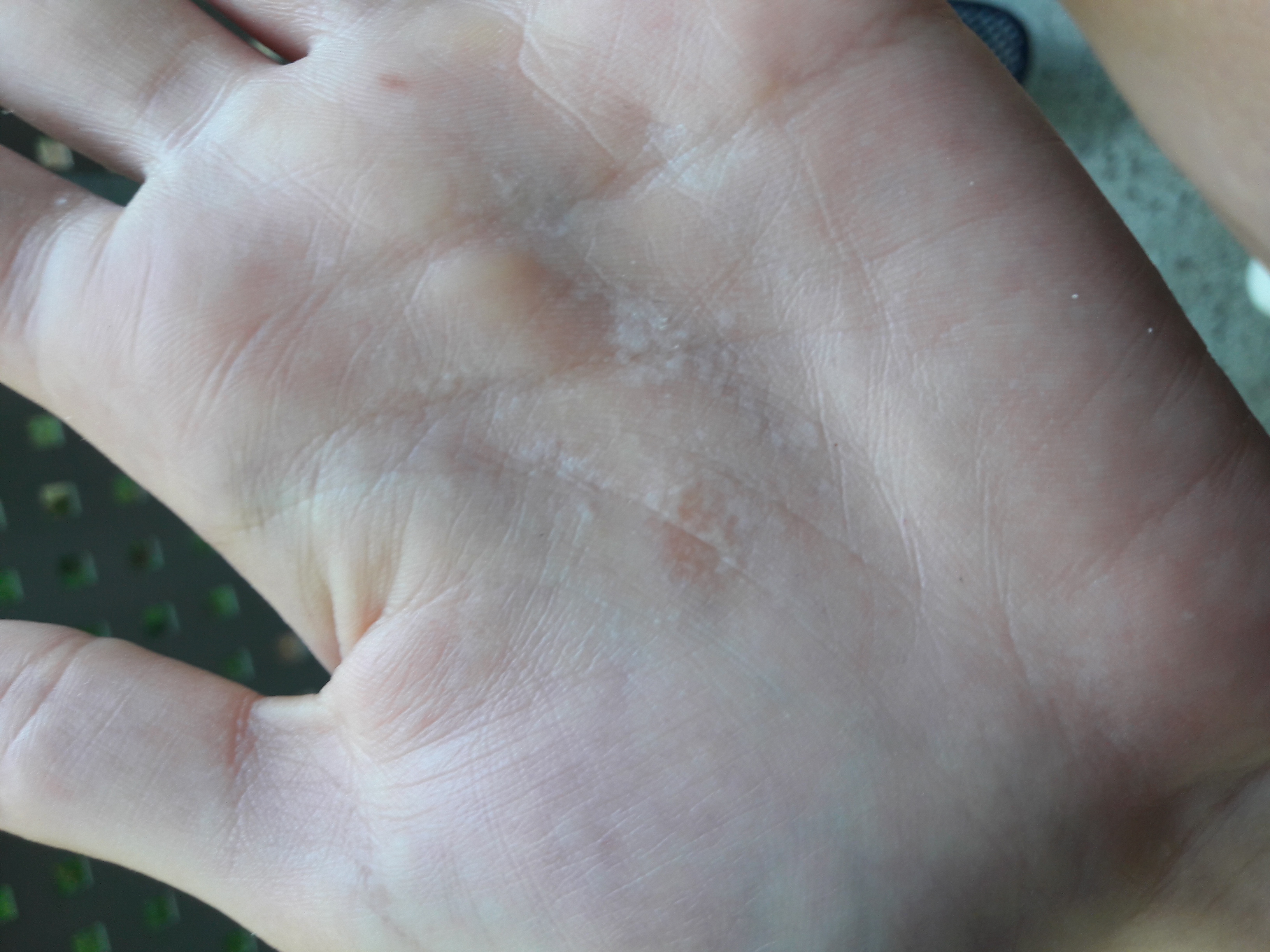 Weiße Flecken auf Handinnenfläche. Was ist das? (Hand, Hautarzt, Hautprobleme)