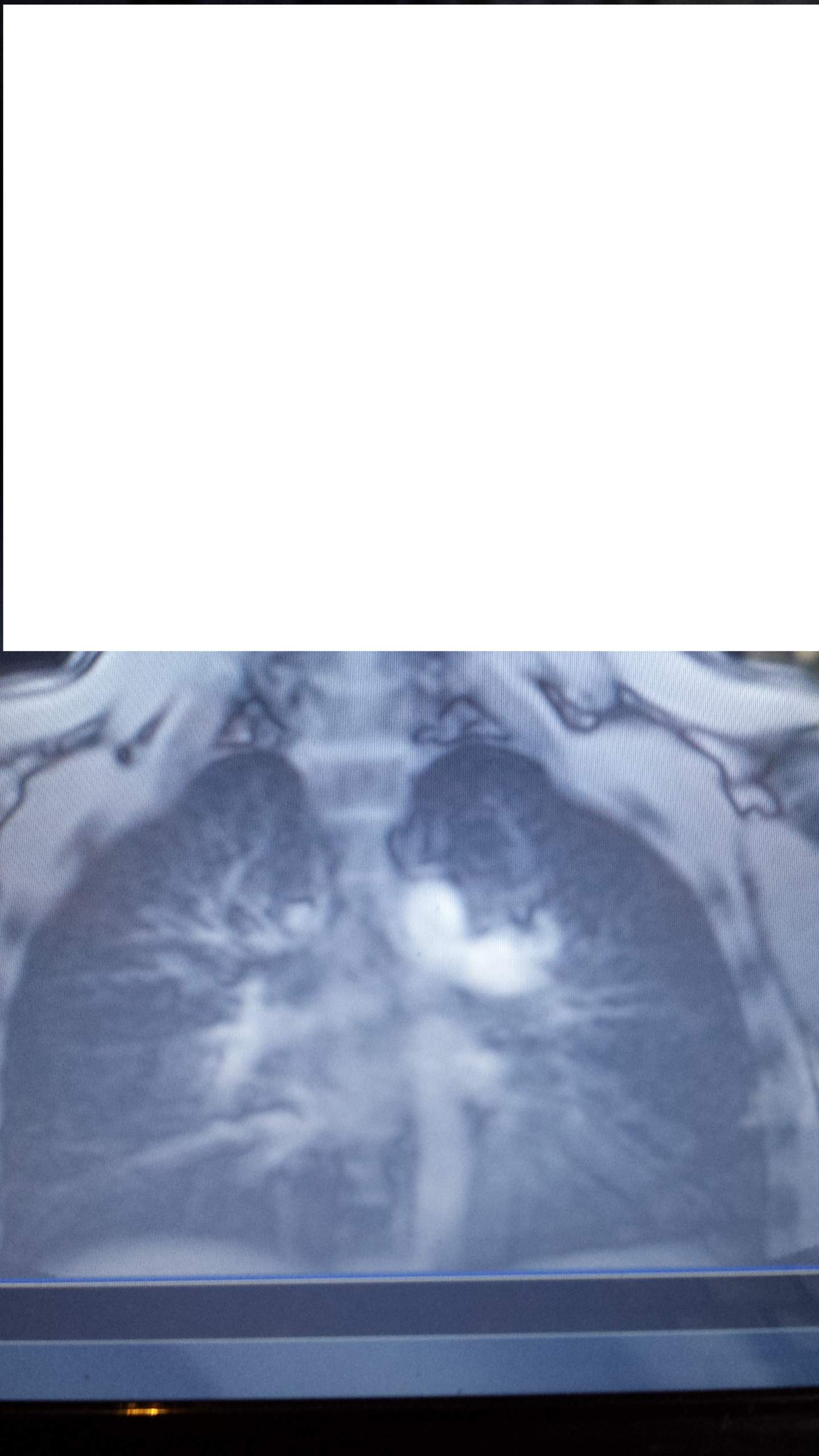 Weisse Flecken Auf Rontgenbild Bei Ruckenschmerzen Rontgen Weisse Flecken Auf Rontgenbild Bei Ruckenschmerzen Rontgen