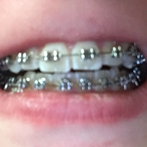 Hier ein Bild von meinen Zähnen  - (Zahnspange, Weiße Flecken)