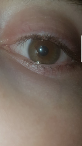 Weisse Flecken Im Auge Was Konnte Das Sein Medizin Augen Optik Weisse Flecken Im Auge Was Konnte Das Sein Medizin Augen Optik