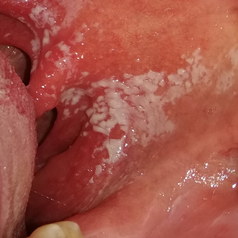 Weisse Flecken Im Hals Foto Gesundheit Und Medizin Gesundheit Pilze Weisse Flecken Im Hals Foto Gesundheit Und Medizin Gesundheit Pilze