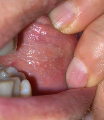 Weiße Flecken im Mund Innenbereich?