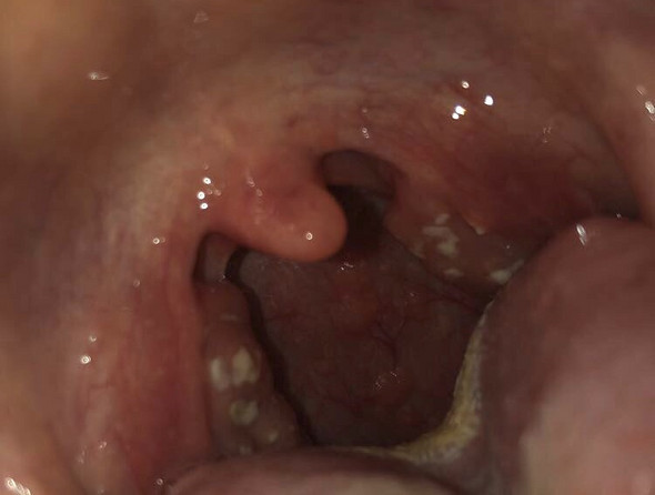 Weisse Flecken Im Rachen Vorsicht Ekeliges Foto Gesundheit Und Medizin Gesundheit Mundhygiene Weisse Flecken Im Rachen Vorsicht Ekeliges Foto Gesundheit Und Medizin Gesundheit Mundhygiene