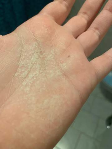 Weisse Flecken In Der Hand Innen Seite Haut Weisse Flecken In Der Hand Innen Seite Haut