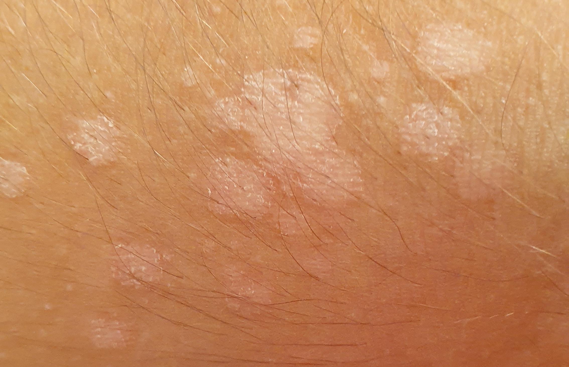 Weisse Flecken Flecke Mit Roter Umrandung Auf Der Haut Hautprobleme Weisse Flecken Flecke Mit Roter Umrandung Auf Der Haut Hautprobleme