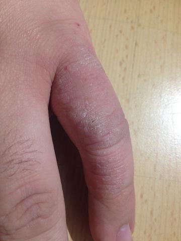 Kleiner Finger li - (Medizin, Haut)